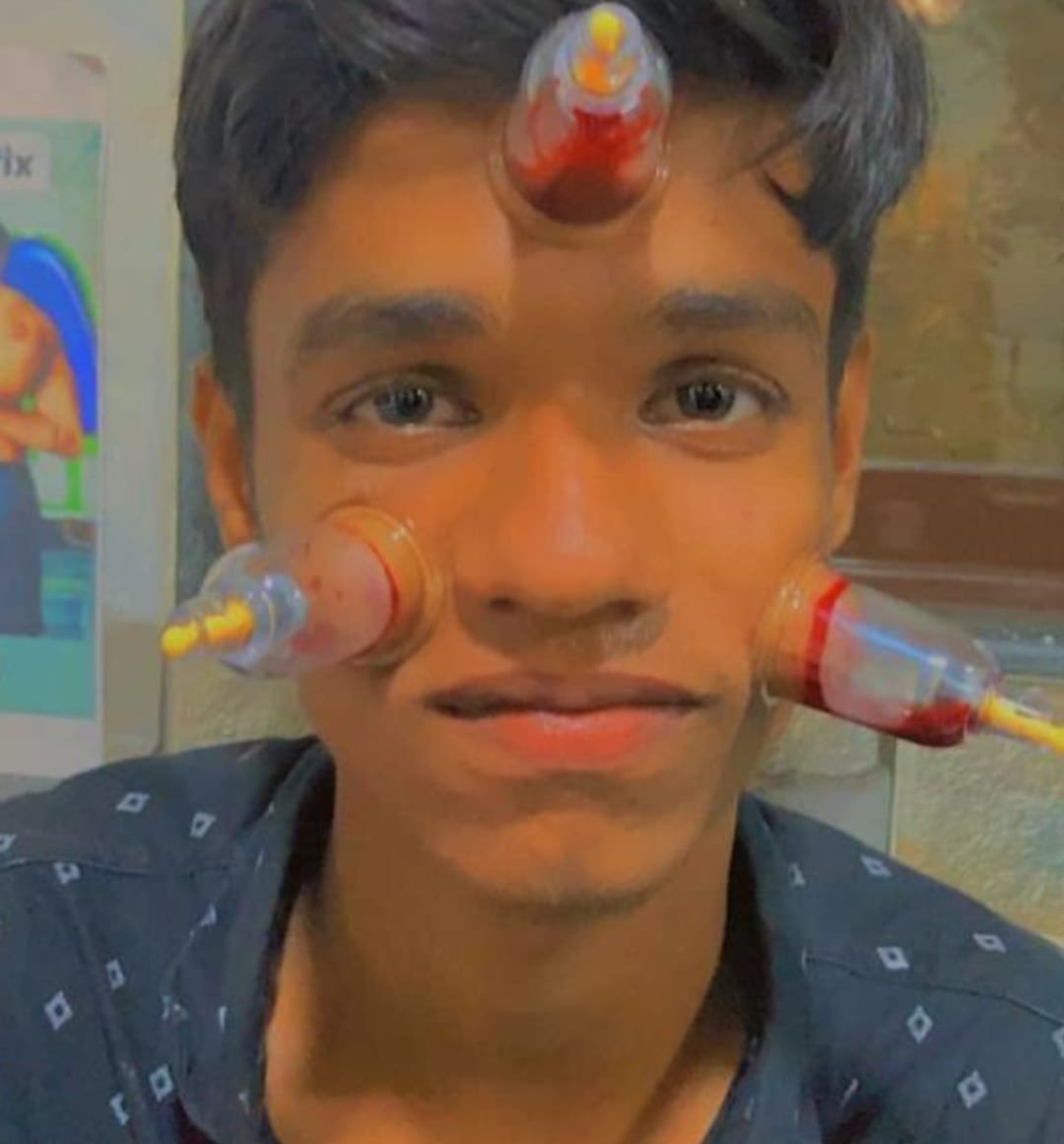 Professional Hijama Cupping Therapy in Mumbai - Certified Therapist